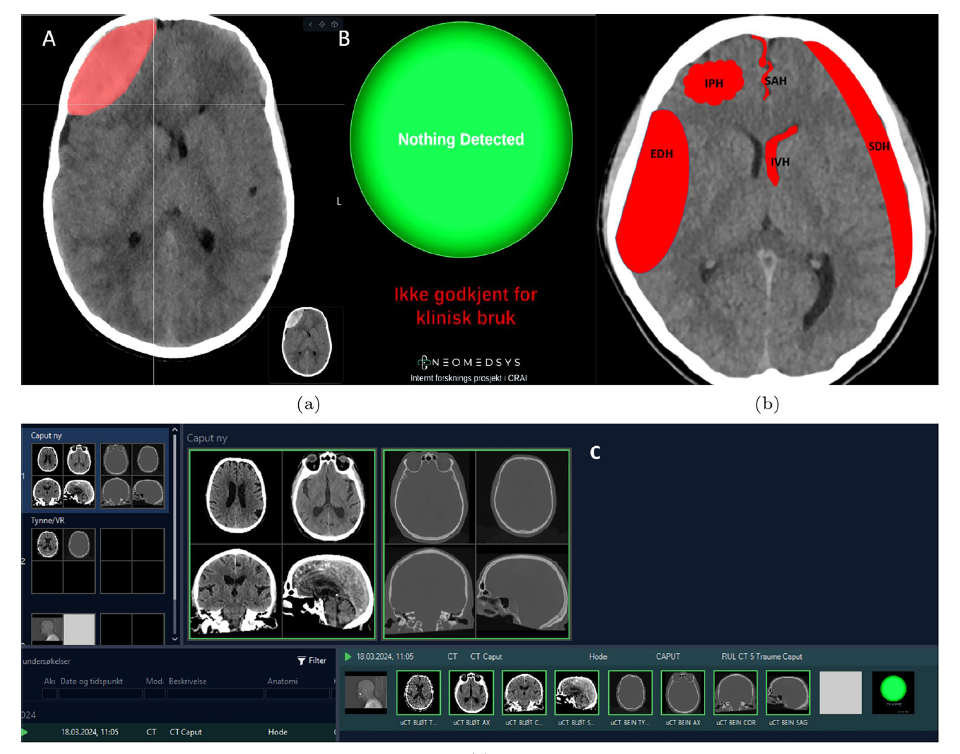 CT-bilder av hjernen med markeringer som viser områder en KI-modell har identifisert som mulige blødninger. Bildene er hentet fra plattformen NeoMedSys.