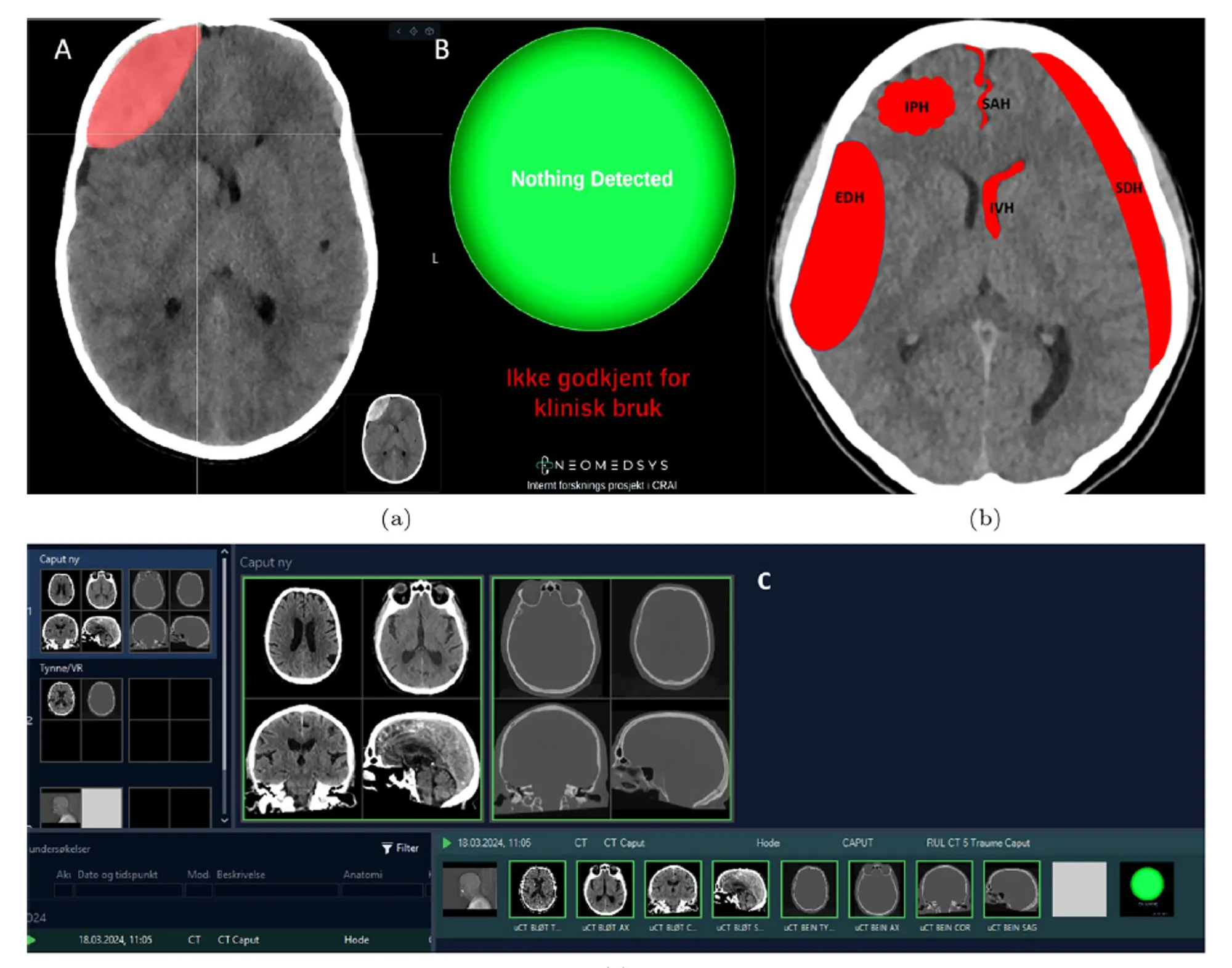 CT-bilder av hjernen med markeringer som viser områder en KI-modell har identifisert som mulige blødninger. Bildene er hentet fra plattformen NeoMedSys.